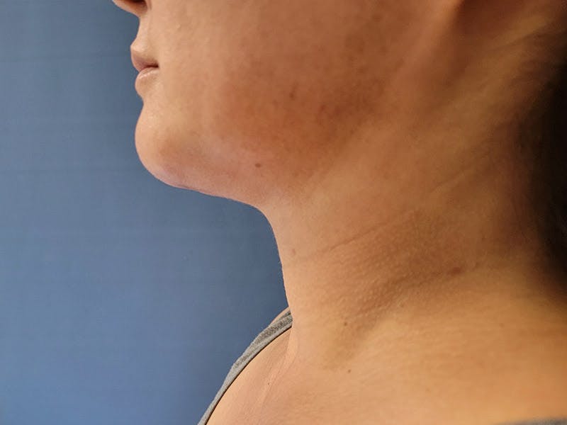 Neck Before & After Gallery - Patient 51821610 - Image 2