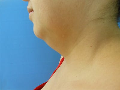 Neck Before & After Gallery - Patient 51821613 - Image 1