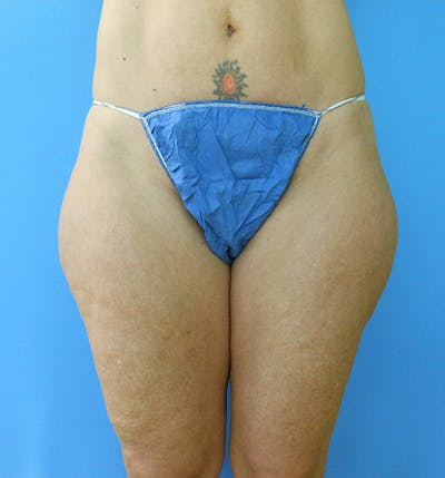 Outer Thigh Before & After Gallery - Patient 51821614 - Image 1