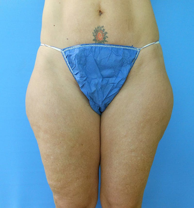 Outer Thigh Before & After Gallery - Patient 51821614 - Image 1