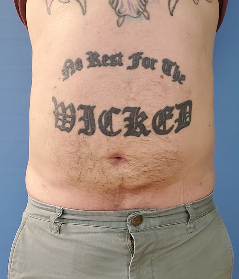 Abdomen Before & After Gallery - Patient 51821612 - Image 4