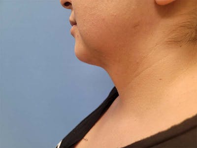 Neck Before & After Gallery - Patient 51821613 - Image 2