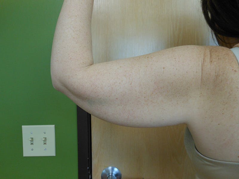 Arms Before & After Gallery - Patient 51821615 - Image 3