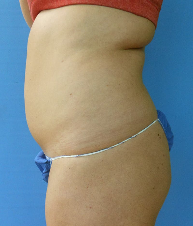 Abdomen Before & After Gallery - Patient 51821620 - Image 1