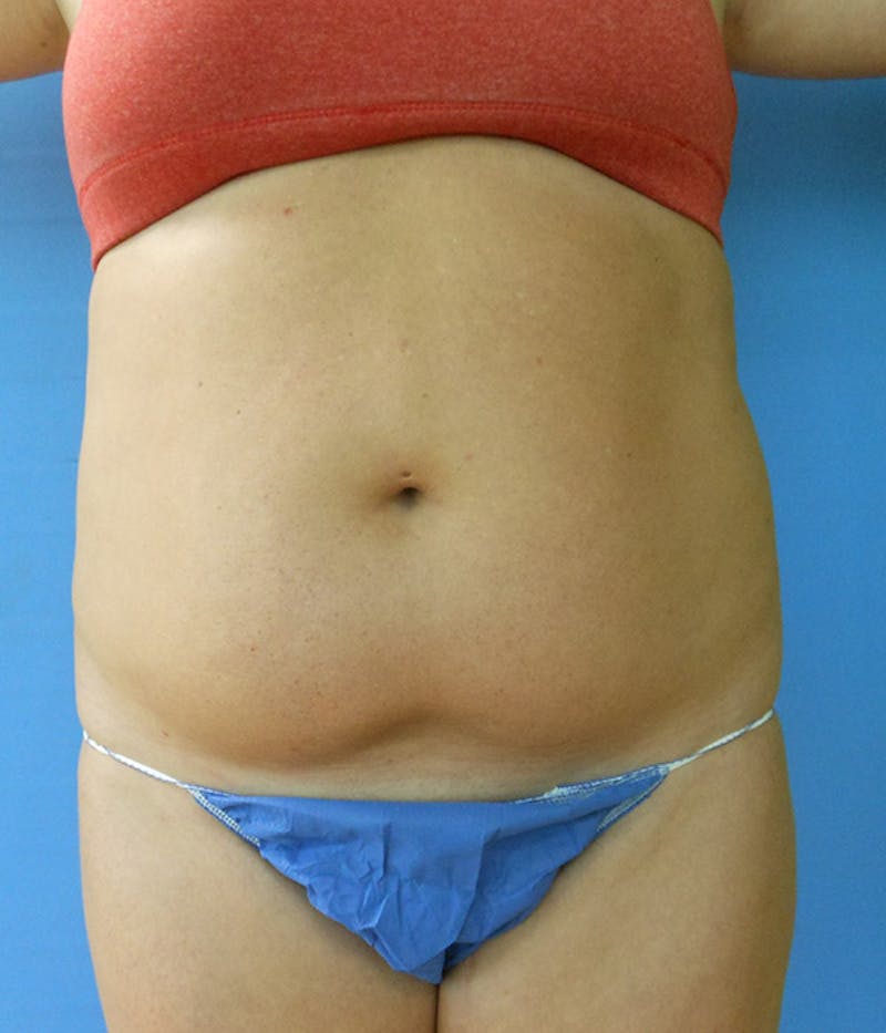 Abdomen Before & After Gallery - Patient 51821620 - Image 3