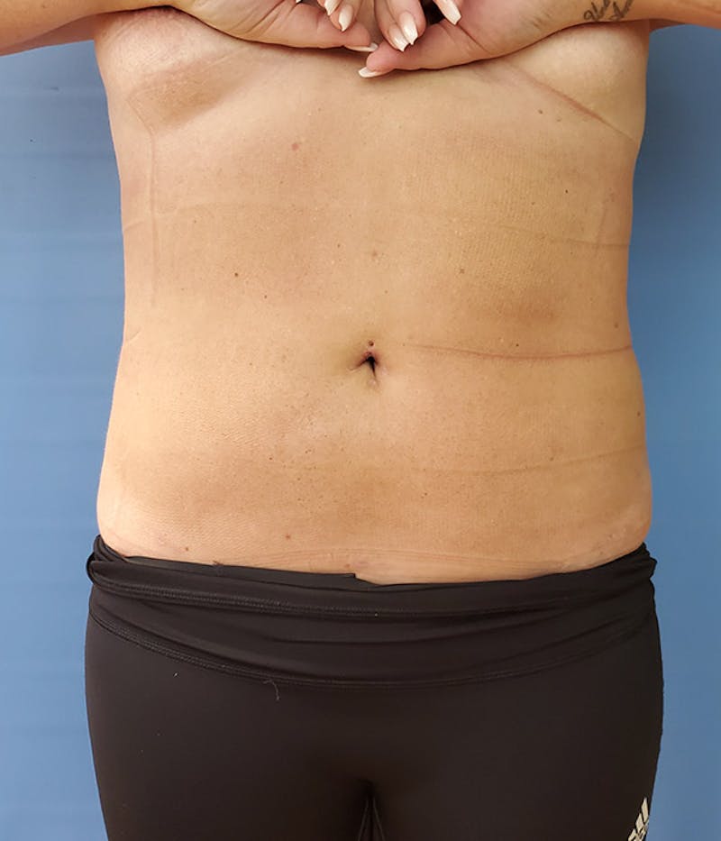 Abdomen Before & After Gallery - Patient 51821620 - Image 4