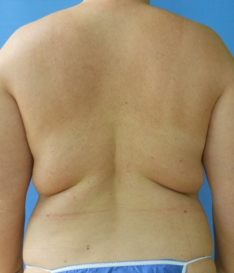 Abdomen Before & After Gallery - Patient 51821620 - Image 5