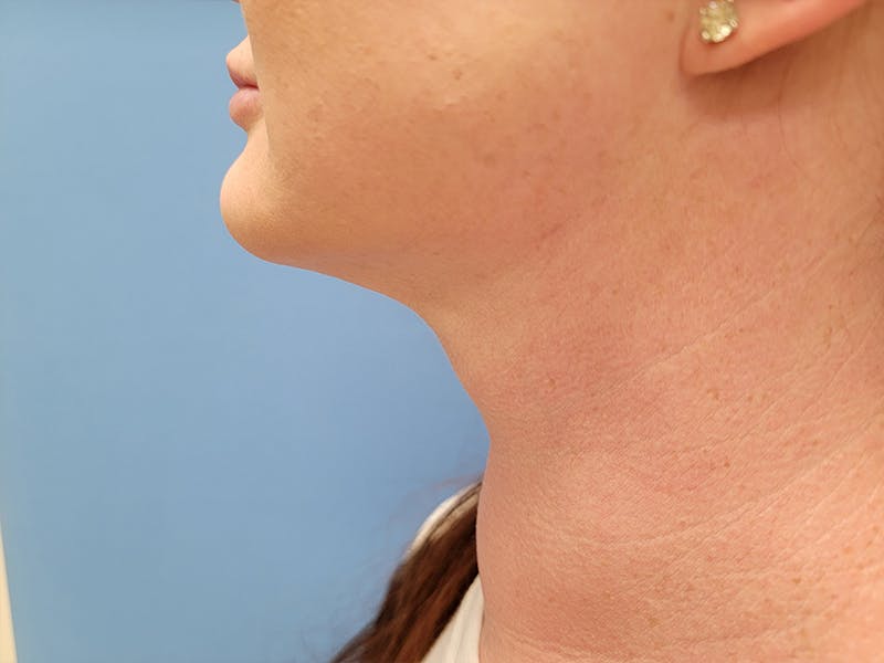 Neck Before & After Gallery - Patient 51821619 - Image 2
