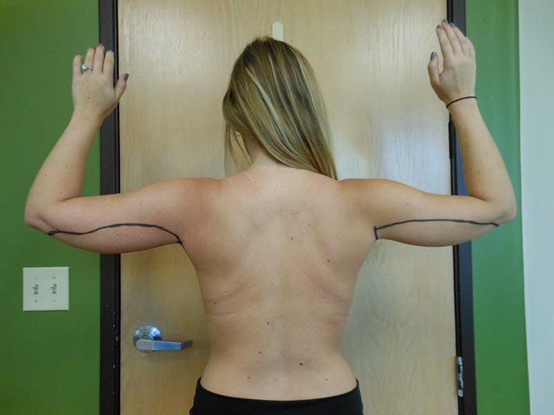 Arms Before & After Gallery - Patient 51821626 - Image 3
