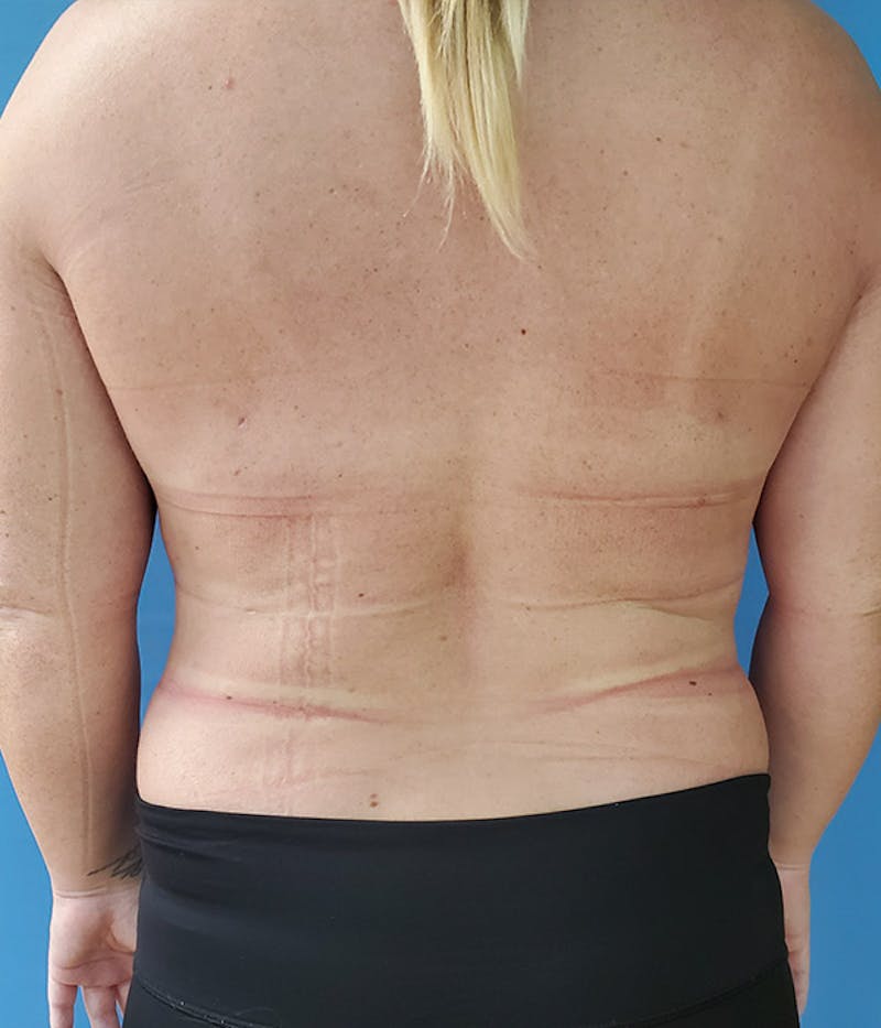 Abdomen Before & After Gallery - Patient 51821620 - Image 6