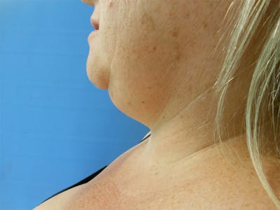 Neck Before & After Gallery - Patient 51821623 - Image 1