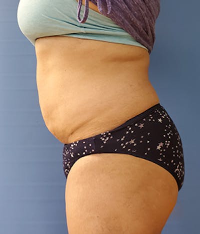 Abdomen Before & After Gallery - Patient 51821622 - Image 2