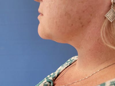 Neck Before & After Gallery - Patient 51821623 - Image 2