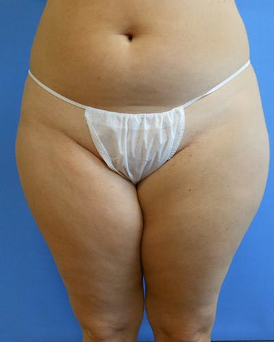 Outer Thigh Before & After Gallery - Patient 51821624 - Image 1