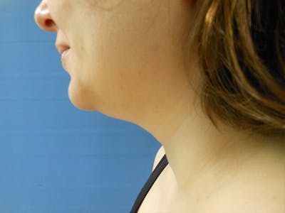 Neck Before & After Gallery - Patient 51821625 - Image 1