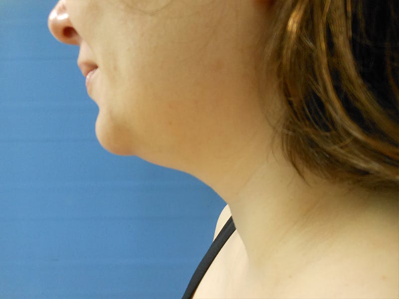 Neck Before & After Gallery - Patient 51821625 - Image 1