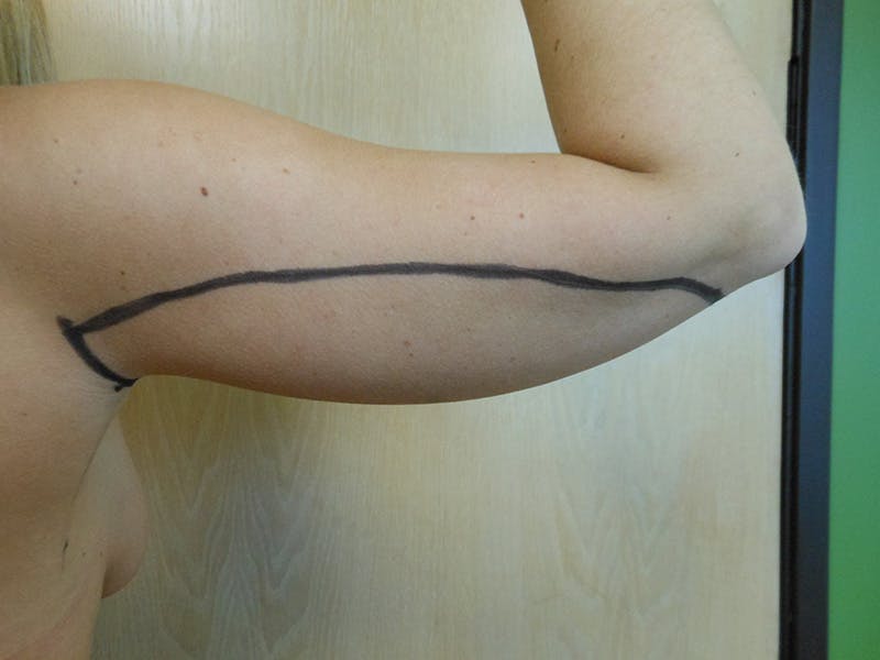 Arms Before & After Gallery - Patient 51821626 - Image 7