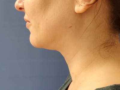 Neck Before & After Gallery - Patient 51821625 - Image 2