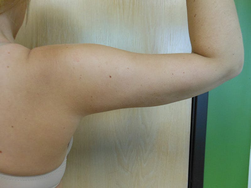 Arms Before & After Gallery - Patient 51821626 - Image 8