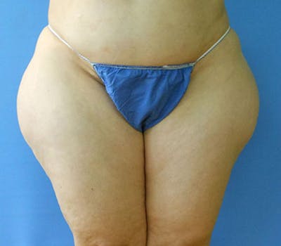 Outer Thigh Before & After Gallery - Patient 51821627 - Image 1
