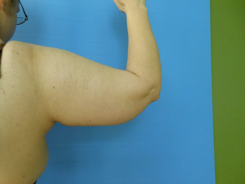 Arms Before & After Gallery - Patient 51821631 - Image 1