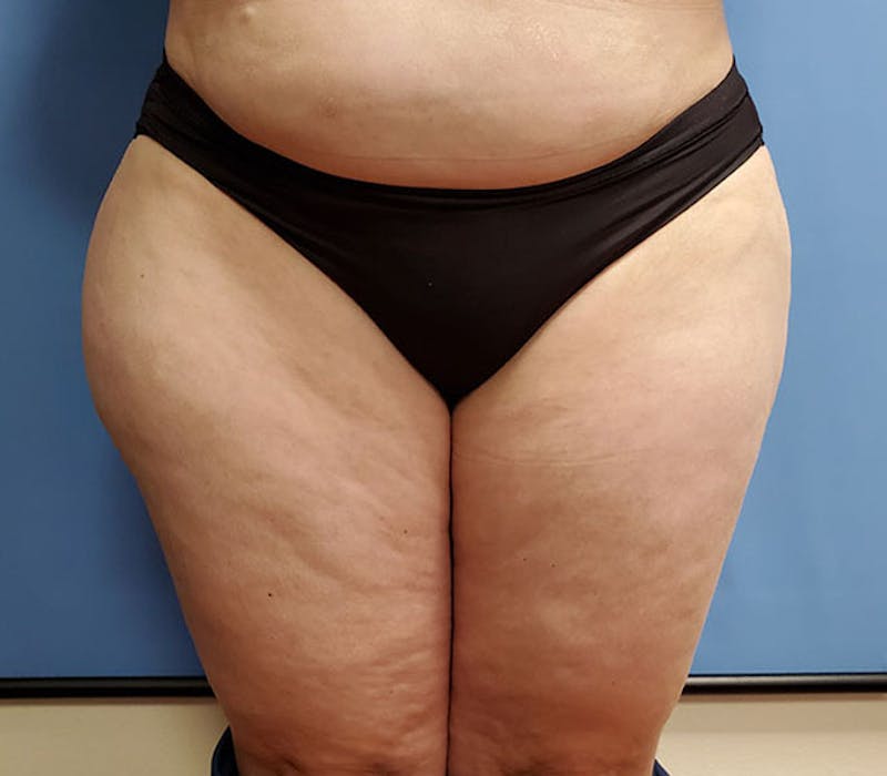 Outer Thigh Before & After Gallery - Patient 51821627 - Image 2