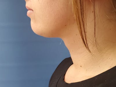 Neck Before & After Gallery - Patient 51821629 - Image 2