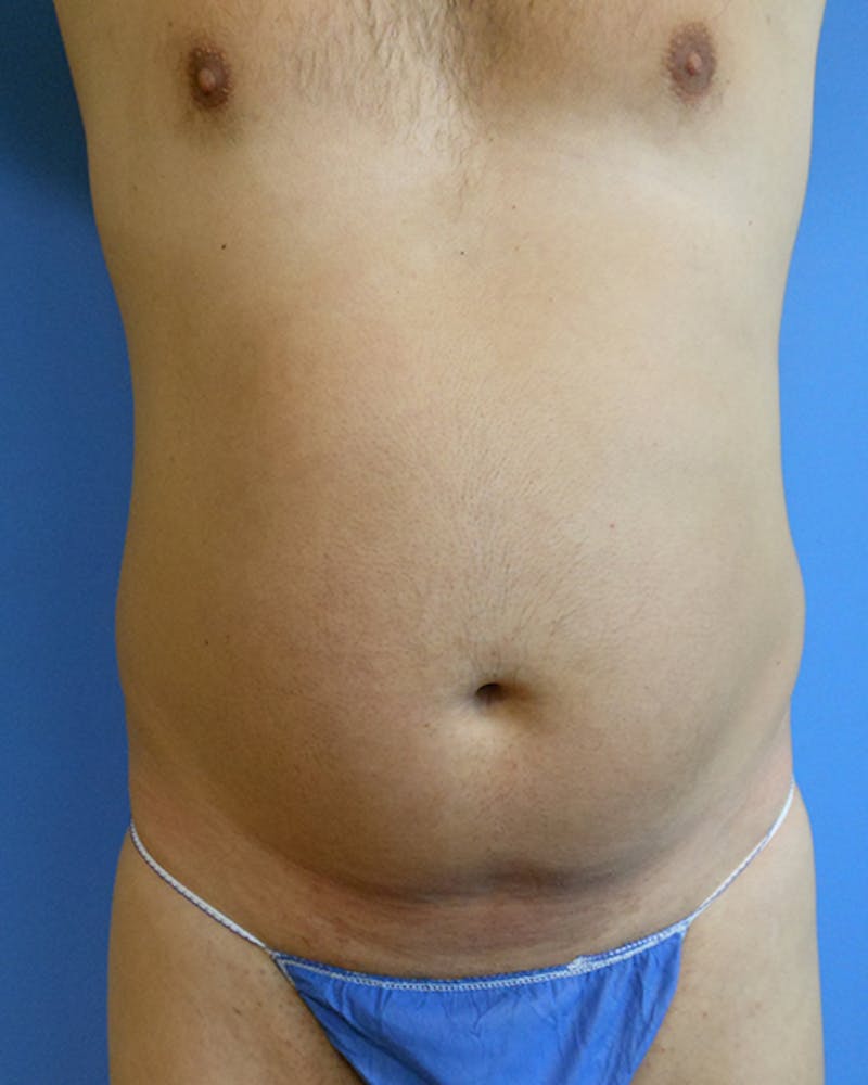 Abdomen Before & After Gallery - Patient 51821632 - Image 1