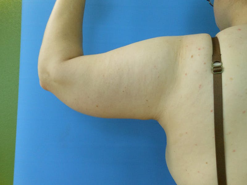 Arms Before & After Gallery - Patient 51821631 - Image 3