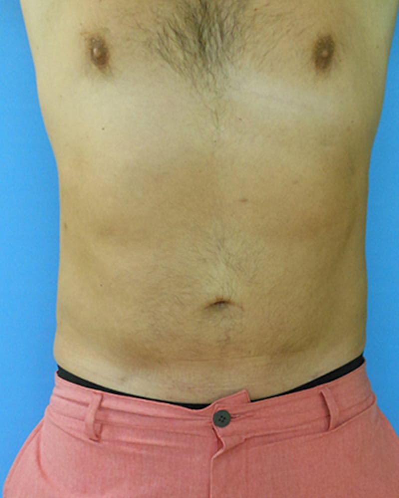 Abdomen Before & After Gallery - Patient 51821632 - Image 2