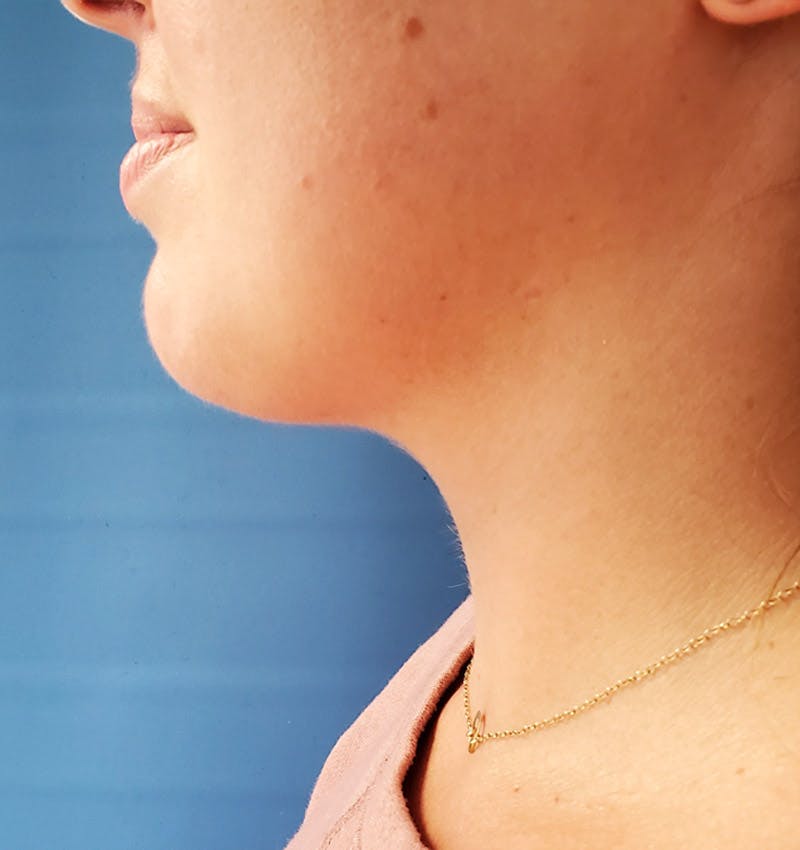 Neck Before & After Gallery - Patient 51821630 - Image 2