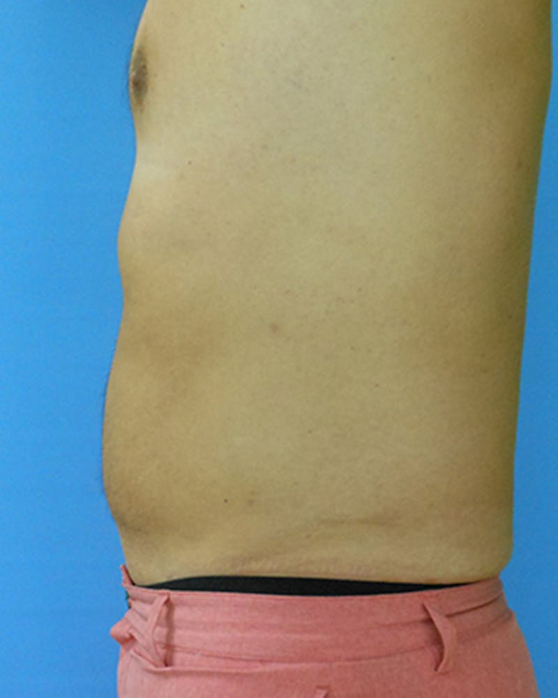 Abdomen Before & After Gallery - Patient 51821632 - Image 4