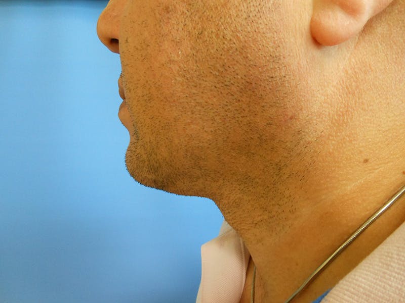 Neck Before & After Gallery - Patient 51821633 - Image 2