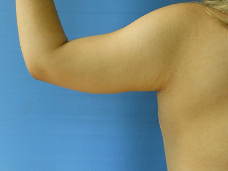 Arms Before & After Gallery - Patient 51821634 - Image 3