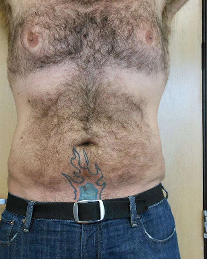 Abdomen Before & After Gallery - Patient 51821635 - Image 2