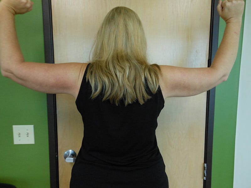 Arms Before & After Gallery - Patient 51821638 - Image 2