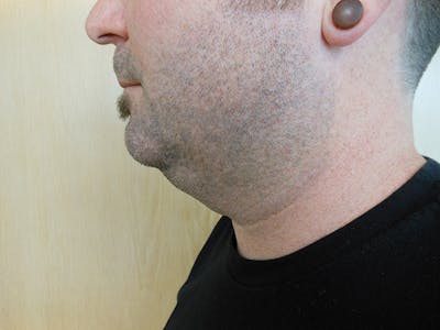 Neck Before & After Gallery - Patient 51821637 - Image 1