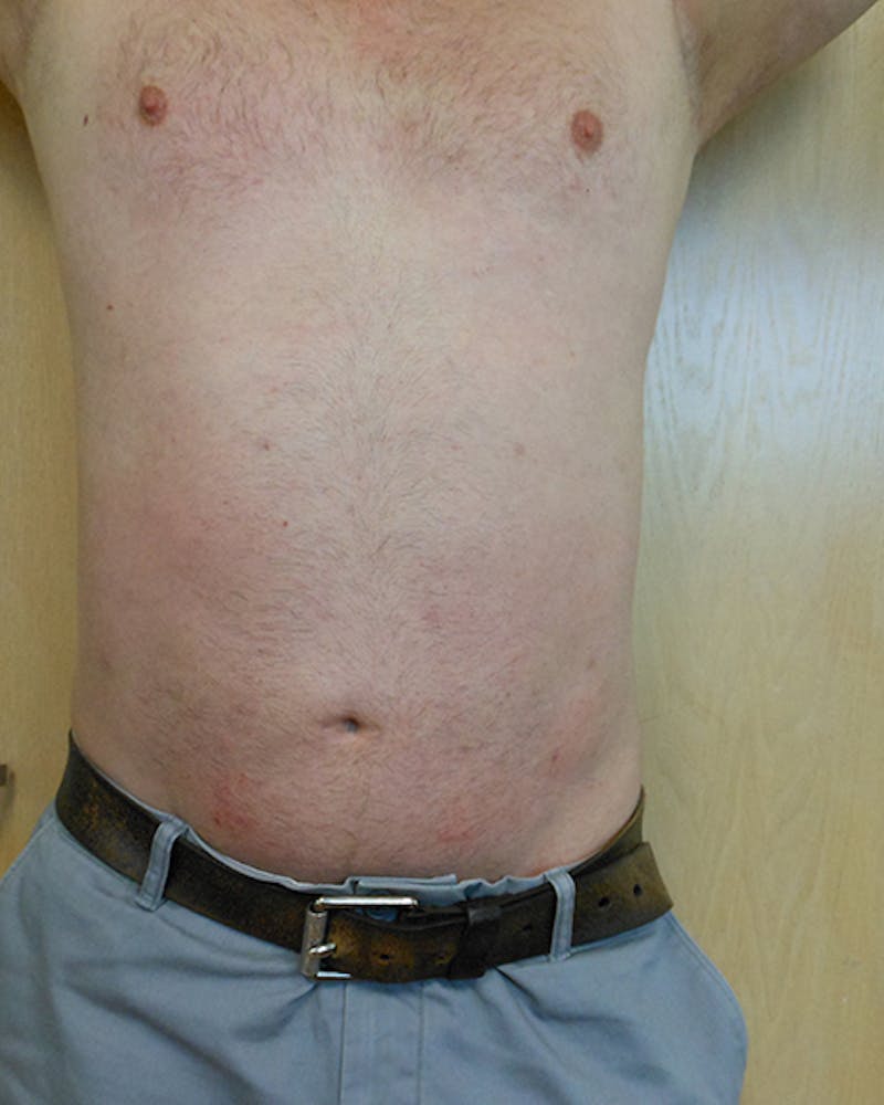 Abdomen Before & After Gallery - Patient 51821639 - Image 2