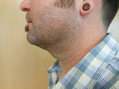 Neck Before & After Gallery - Patient 51821637 - Image 2