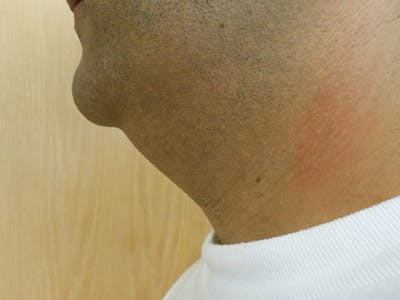 Neck Before & After Gallery - Patient 51821641 - Image 1