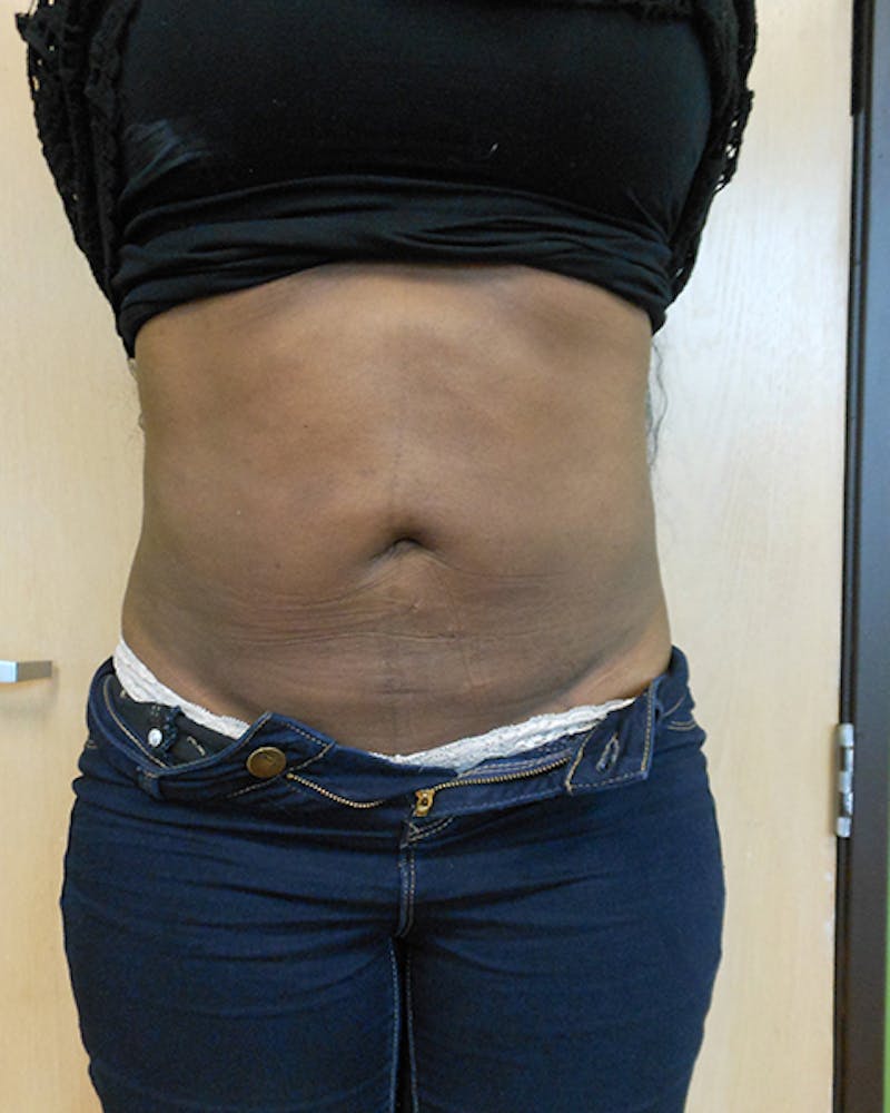 Abdomen Before & After Gallery - Patient 51821644 - Image 2