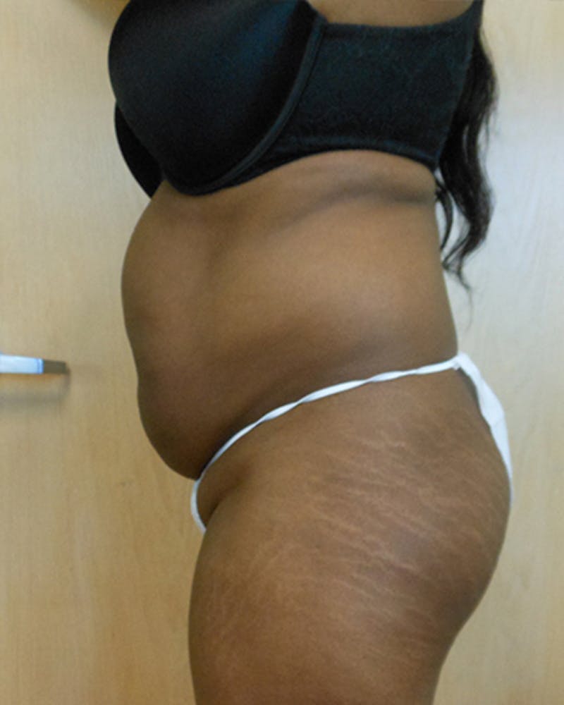 Abdomen Before & After Gallery - Patient 51821644 - Image 3