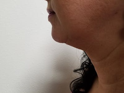 Neck Before & After Gallery - Patient 51821643 - Image 2