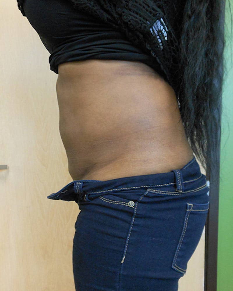 Abdomen Before & After Gallery - Patient 51821644 - Image 4