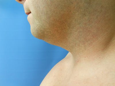 Neck Before & After Gallery - Patient 51821645 - Image 1