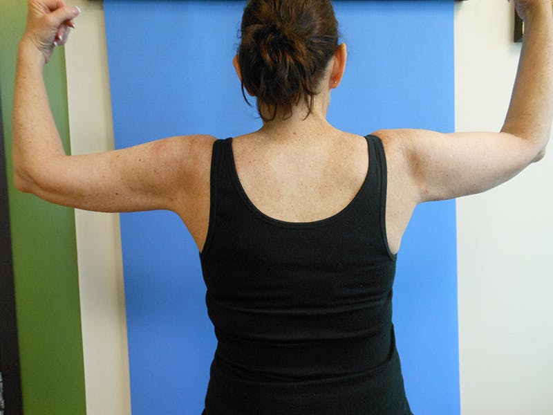 Arms Before & After Gallery - Patient 51821648 - Image 2