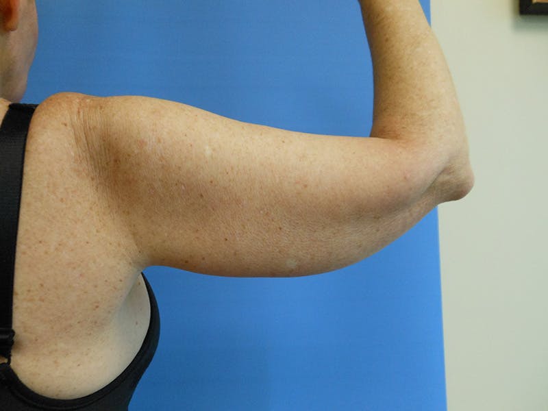 Arms Before & After Gallery - Patient 51821648 - Image 3