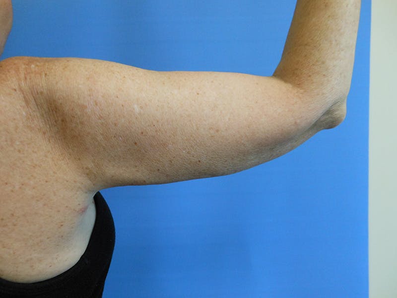 Arms Before & After Gallery - Patient 51821648 - Image 4