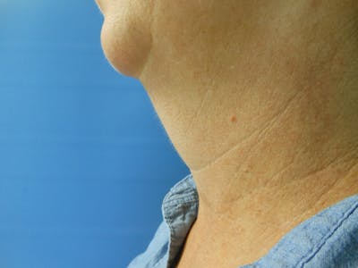 Neck Before & After Gallery - Patient 51821647 - Image 1