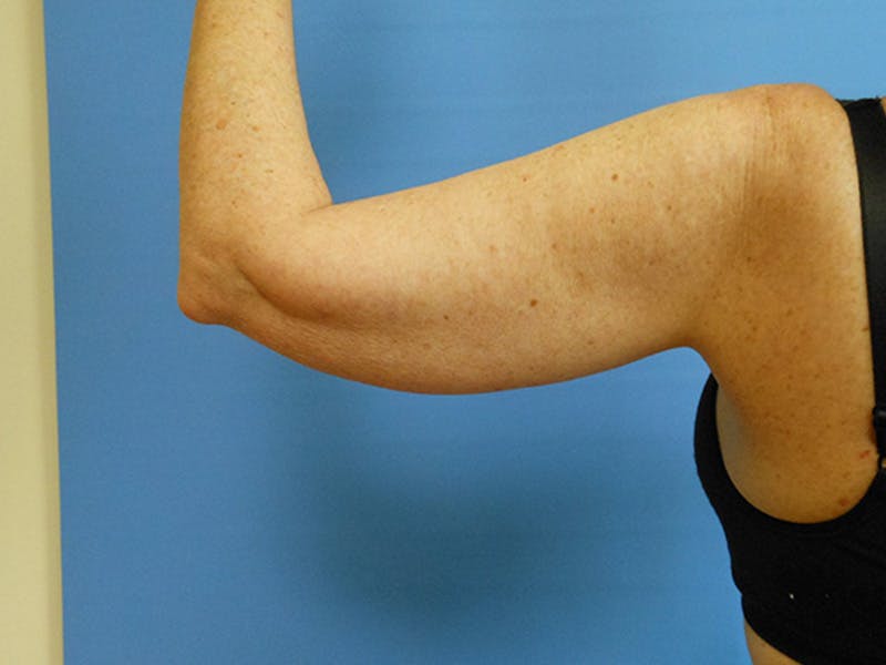 Arms Before & After Gallery - Patient 51821648 - Image 5